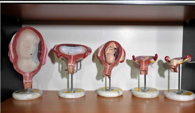 مولاژ های رحم در دوره زمانی بارداری